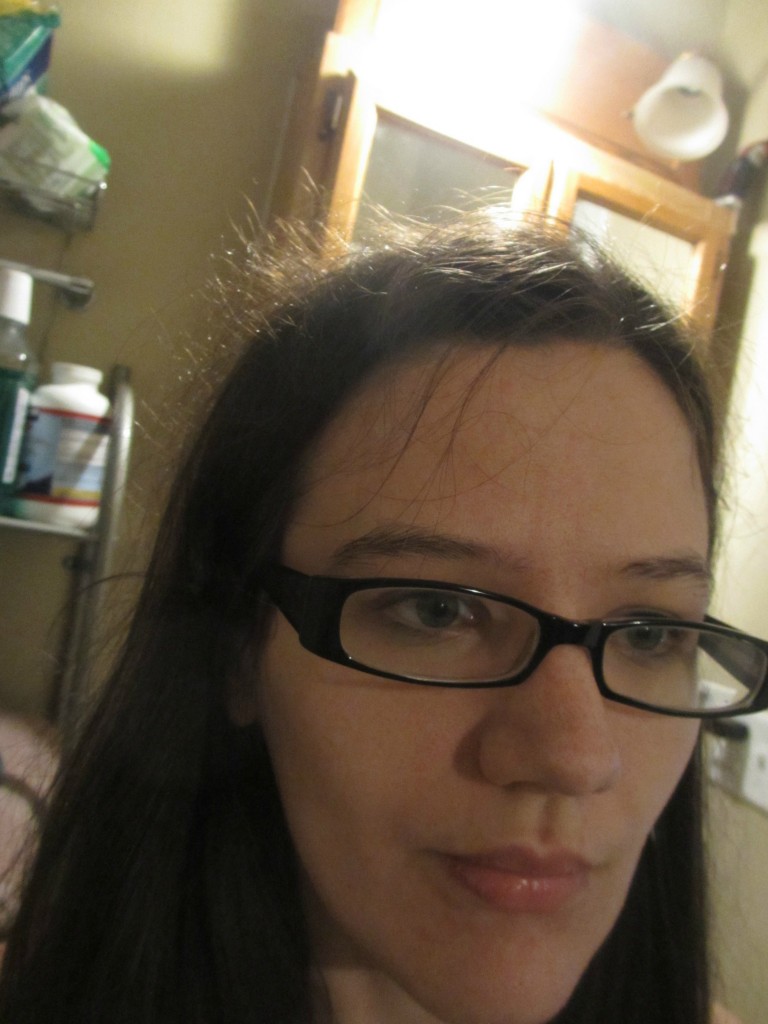 Hair Breakage And Ehlers Danlos Syndrome